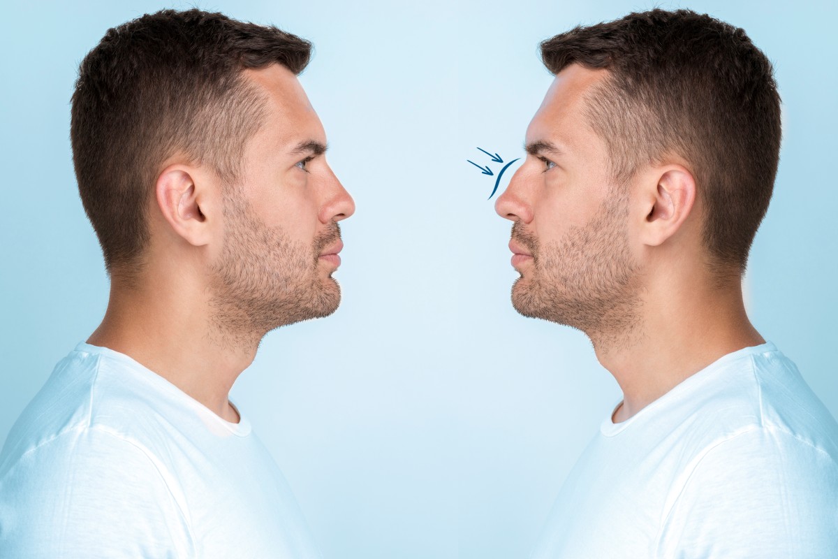 Best Rhinoplasty Surgeons in Islamabad: Why Patients Trust Dr. Hijrat